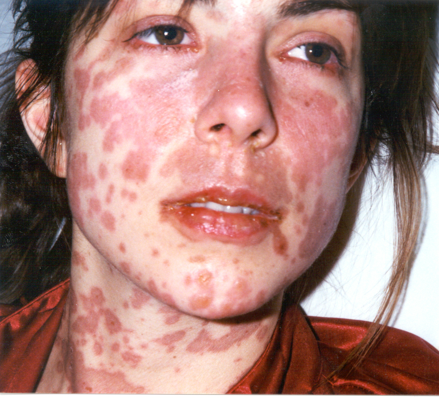 Stevens Johnson syndrome / toxic epidermal necrolysis ...