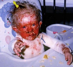 Julie McCawley, 12-months-old, sits in a high chair, bandaged and on a feeding tube suffering from Stevens-Johnson Syndrome.